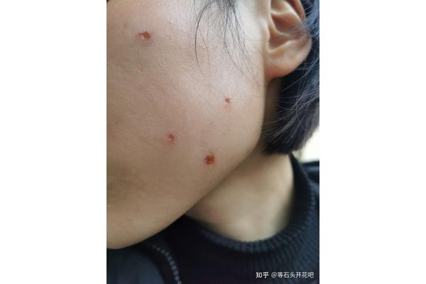 Spot点痣后几天可以洗脸,祛痣后多久可以洗脸?